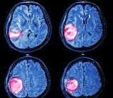 Tumor cerebro y radiación Tumor cerebro y radiación