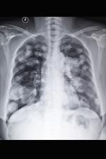 Cáncer de pulmón Cáncer de pulmón