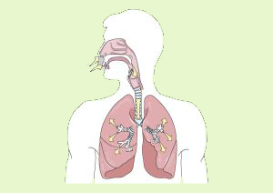 Cáncer pulmón Cáncer pulmón